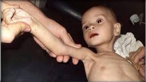 أحد اطفال سوريا المحتاجين للعنايةالصحية